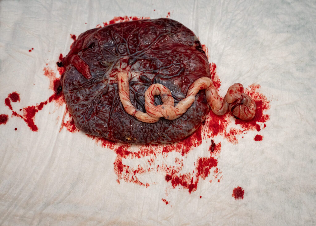 An umbilical cord (still connected to the placenta) is shaped into the word "love" 