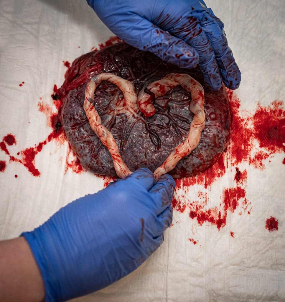A doula at St. Michael Medical Center in Silverdale, WA arranges an umbilical cord into a heart.