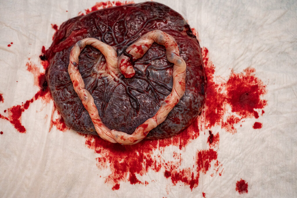 An umbilical cord (still attached to the placenta) is arranged into the shape of a heart.