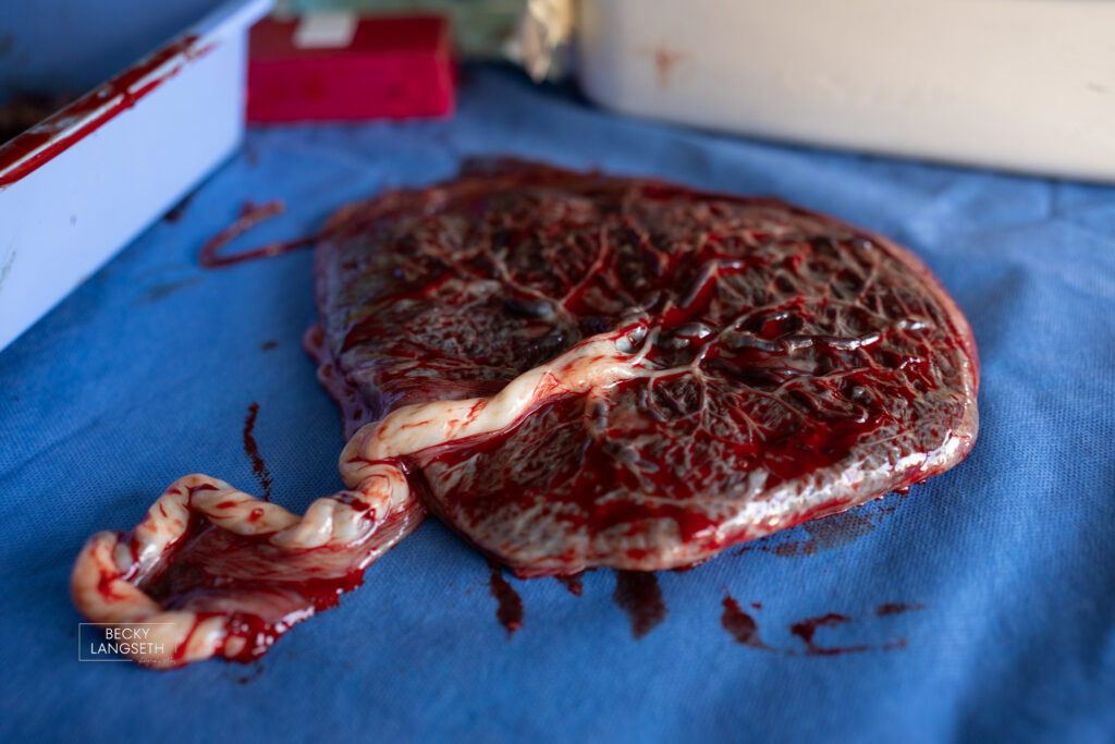 A placenta is on the table with the tree of life visible.