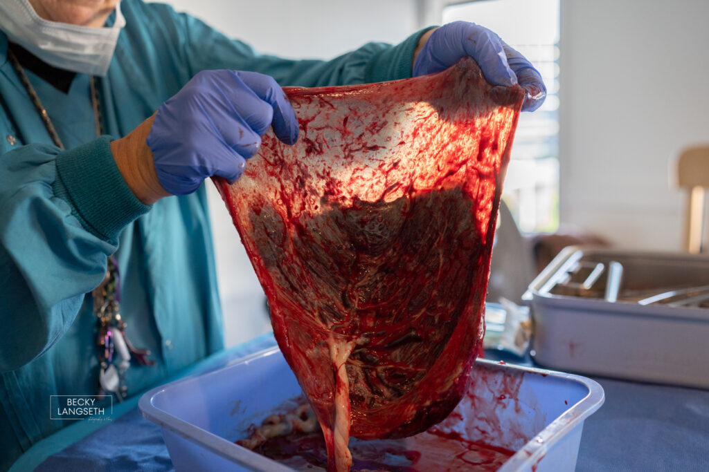 A placenta is held up by a nurse and the light is shining through the membrane.
